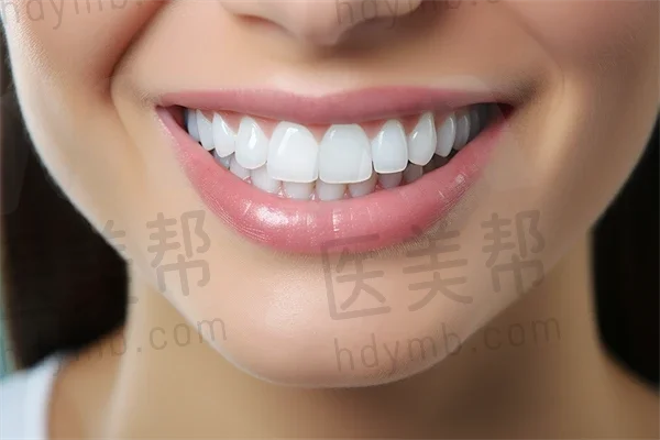 三门峡泊菲特口腔门诊部牙齿美白费用现价仅需488元起，原价688元起，优惠活动进行中！