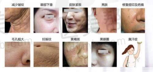 隆胸手术实例