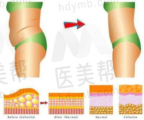 刘溪医生及其双眼皮实例