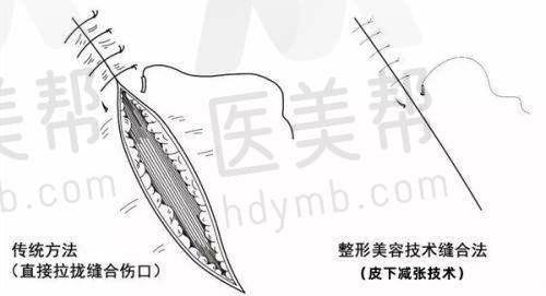 隆鼻手术体验