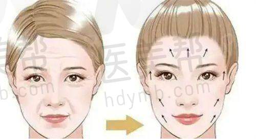 眼部整形实例