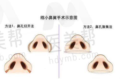 眼部整形优势