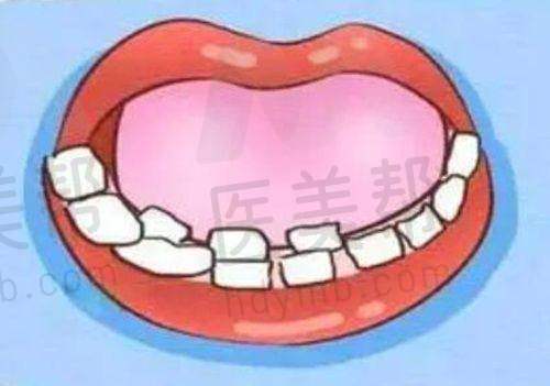 智齿一半长在肉里经常发炎疼痛的治疗方法