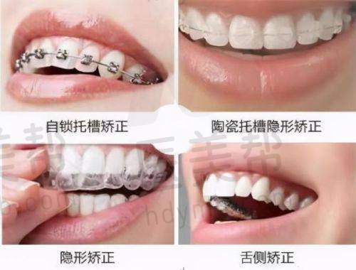 三明诗艺口腔患者实例分享