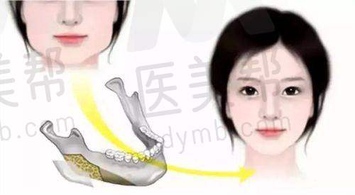 其他整形项目及价格