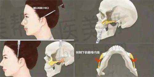 水动力吸脂价格情况