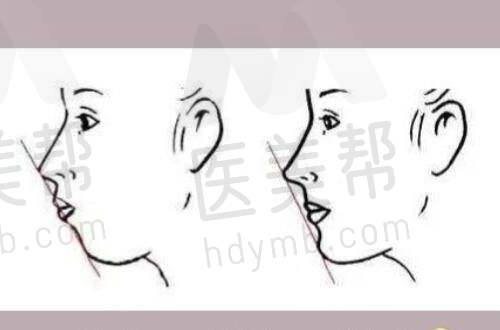 注射填充精灵耳操作细节