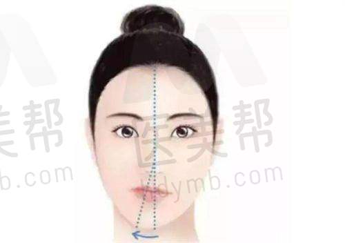 精灵耳整形手术具体过程